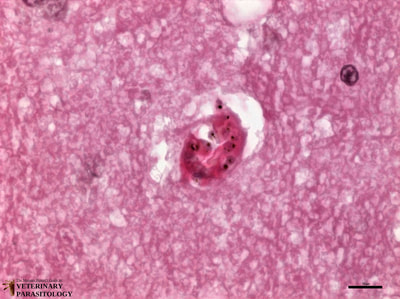 Sequestration of Plasmodium falciparum in cerebral vessels (aka., cerebral malaria), cross-section of human brain