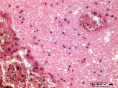 Sequestration of Plasmodium falciparum in cerebral vessels (aka., cerebral malaria), cross-section of brain
