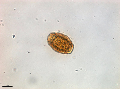 Dioctophyma renale egg, outer surface, urine sediment