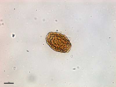Dioctophyma renale egg, urine sediment