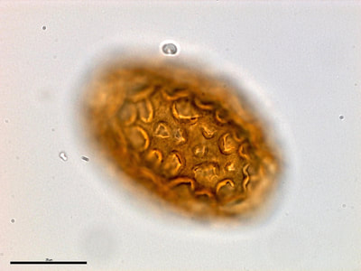 Dioctophyma renale egg, outer surface, urine sediment
