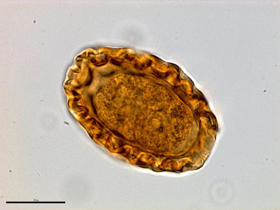 Dioctophyma renale egg, urine sediment