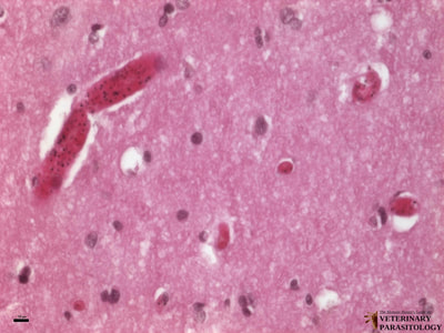 Sequestration of Plasmodium falciparum in cerebral vessels (aka., cerebral malaria), cross-section of human brain