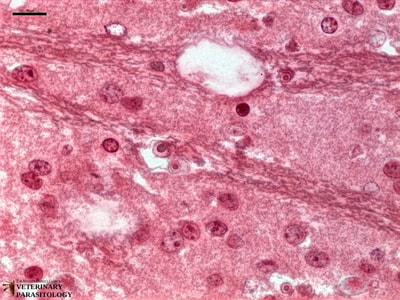 Naegleria fowleri trophozoites in cerebrum