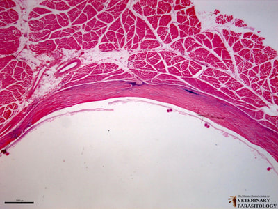 Hydatid cyst of Echinococcus granulosus