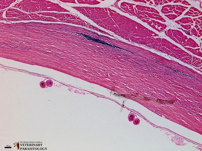 Hydatid cyst of Echinococcus granulosus