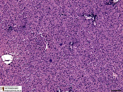 Plasmodium sp. pre-erythrocytic schizonts (exo-erythrocytic form) in human liver