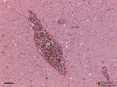 Sequestration of Plasmodium falciparum in cerebral vessels (aka., cerebral malaria), cross-section of brain