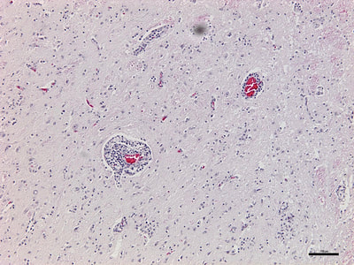 Sarcocystis neurona in equine spinal cord, perivascular lymphocytic infiltrate