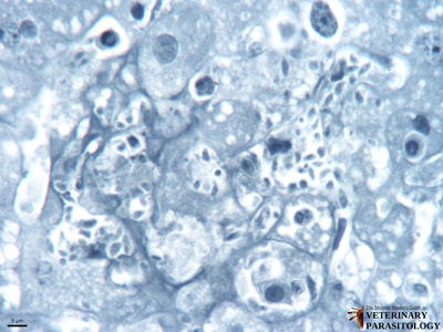 Toxoplasma gondii tachyzoites in liver (i.e., hepatic toxoplasmosis)